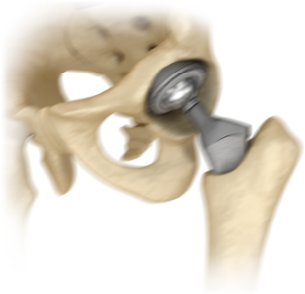 Hip Implant