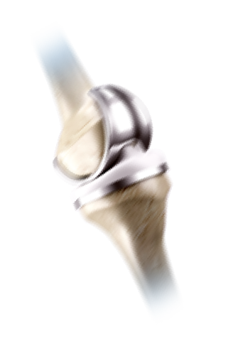 Knee Implant